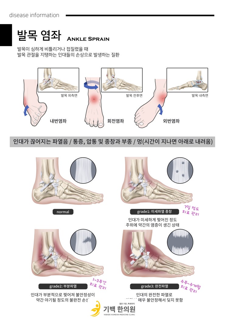 발목 염좌 (Ankle Sprain) [단대오거리 기백한의원 / 금광동 발목삐었을때] : 네이버 블로그