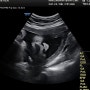 임신35주 막달검사 9개월 만삭임산부 선택제왕으로 수술날짜결정