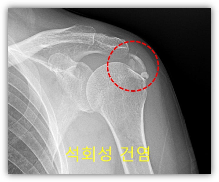 뉴핌스 치료 : 어깨석회성 건염, 석회분쇄흡입술