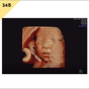 임신 34주 임산부 독감주사 임신 부종