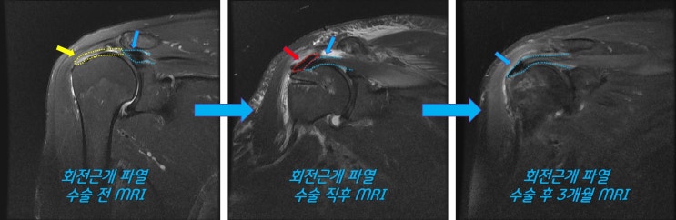 완전히 복원되지 않는 광범위 회전근개 파열 :  인조인대를 이용한 회전근개 봉합술 및 보강술 결과
