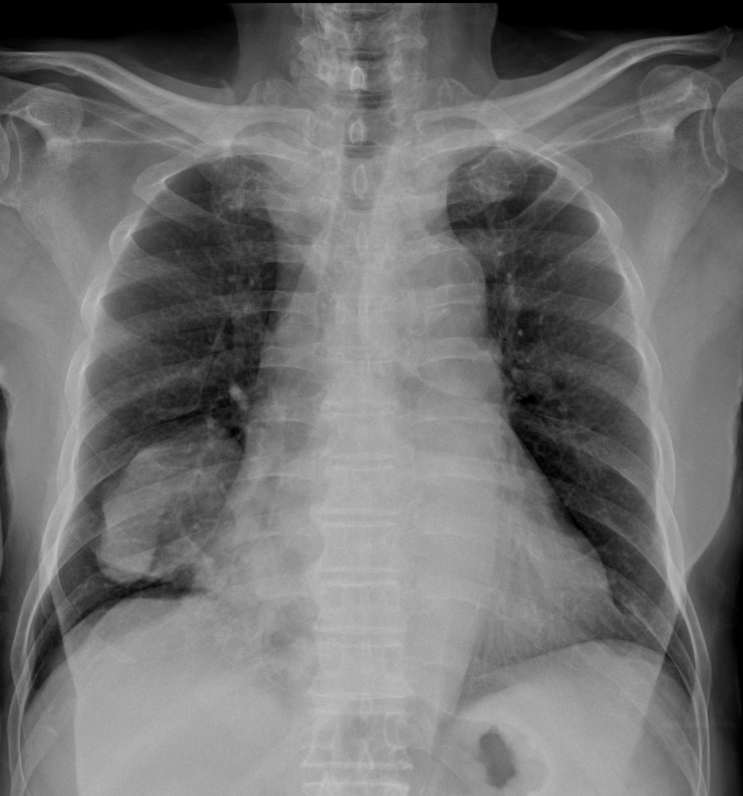 [흉부엑스레이] 기운이 없고 숨이 차요 / 폐암(lung cancer) : 네이버 블로그