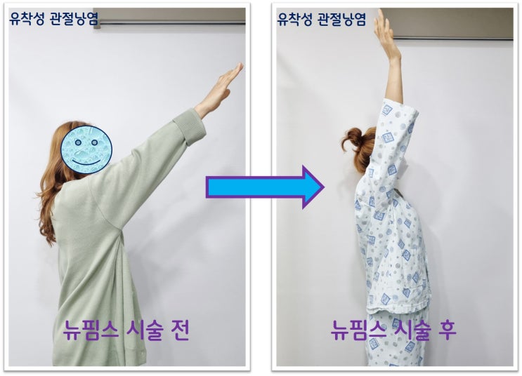 오십견: 어깨 유착성 관절낭염에 대한 뉴핌스 치료 결과