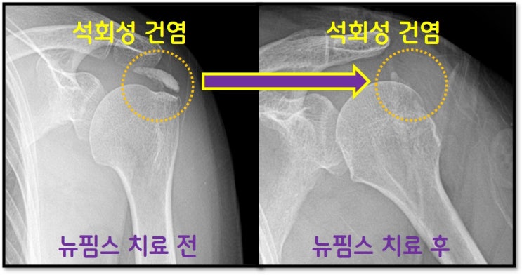 어깨 석회성 건염 수술 없이 뉴핌스 치료(석회분쇄흡입술) 로 탈출!!!