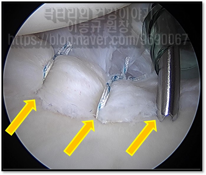 어깨 통증. 잘못된 진단으로 고생하지 말자!!
