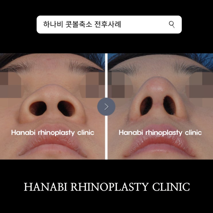 콧구멍 작아지는 법 알아보기 : 네이버 블로그