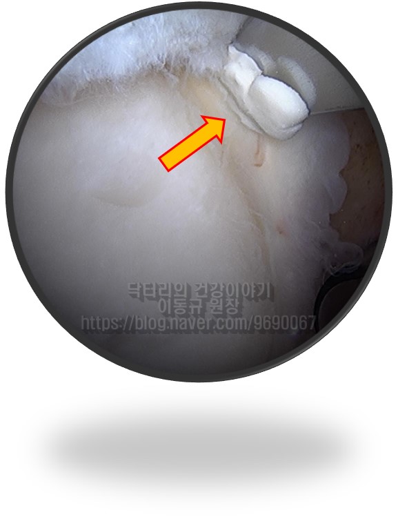 관절와순에 발생된 석회성 건염. 진단 및 치료에 대한 고찰