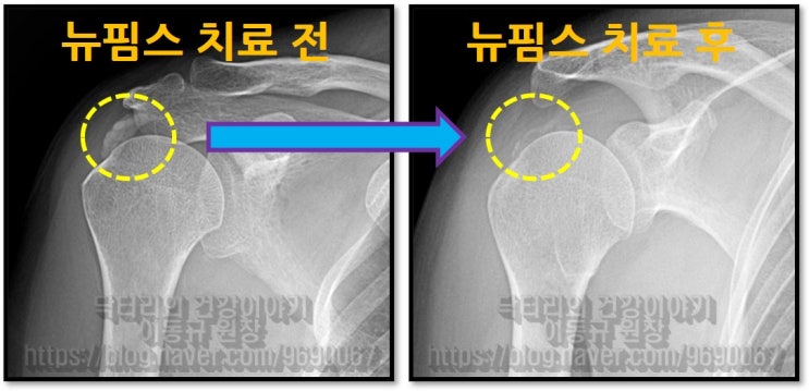 어깨 석회성 건염 수술없이 치료하는 뉴핌스치료
