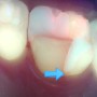 양심치과/치과 과잉진료에 대한 생각 - 치과 검진 시 진단의 정확성을 높여주는 형광검사 Q-ray의 필요성