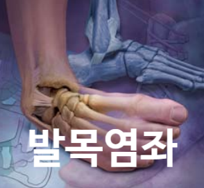 발목 염좌 - 서귀포 서울성모재활의학과의원 : 네이버 블로그
