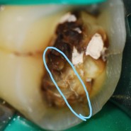 금이 간 치아의 신경치료