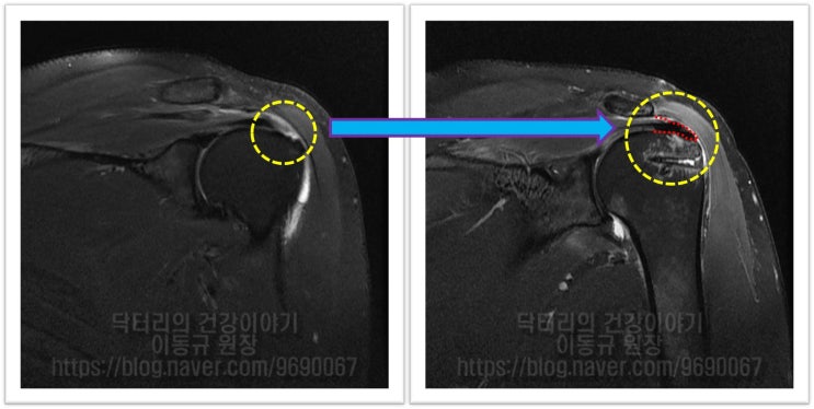 어깨 회전근개 파열에서 보강술이 필요한 경우