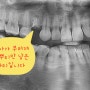 문정동치과 발치 후 바로 심는 임플란트