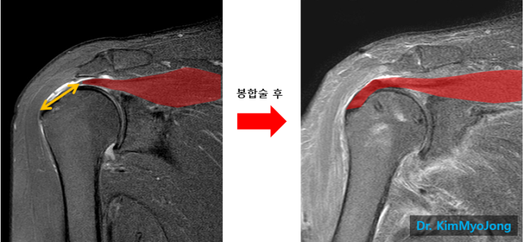 [어깨/회전근개파열]대(大)파열 혹은 광범위파열의 치료 - 봉합 긴장도는 약하게 고정은 강하게 : 네이버 블로그