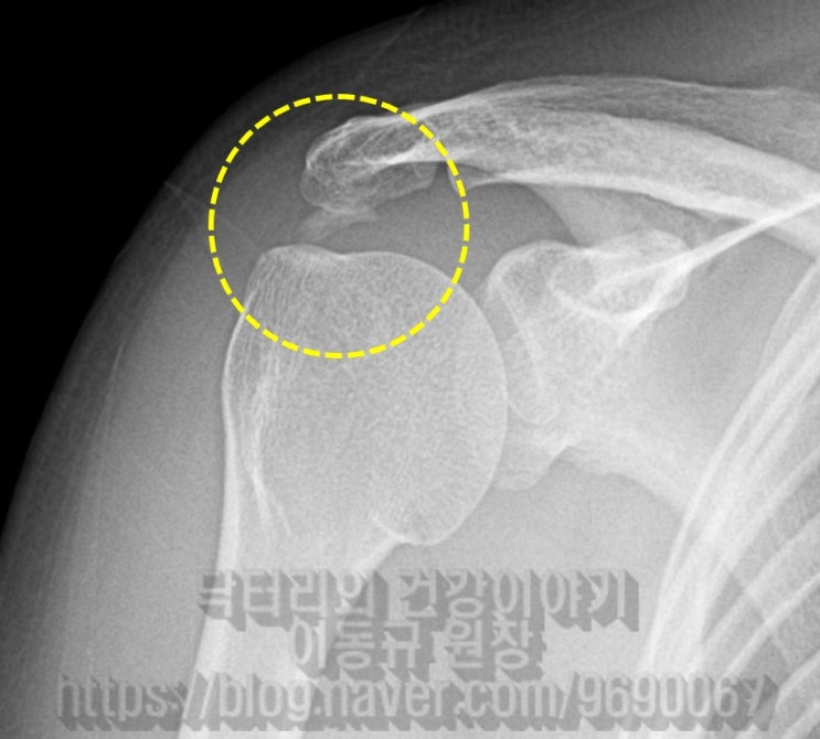 어깨 석회성 건염 : 수술 없이 치료하는 뉴핌스치료 (석회분쇄흡입술)