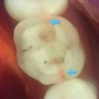 씹을 때 시큰+찌릿한 치아통증 : 어금니 크랙 치아 - 항상 균열 선이 보이는 것은 아닙니다.