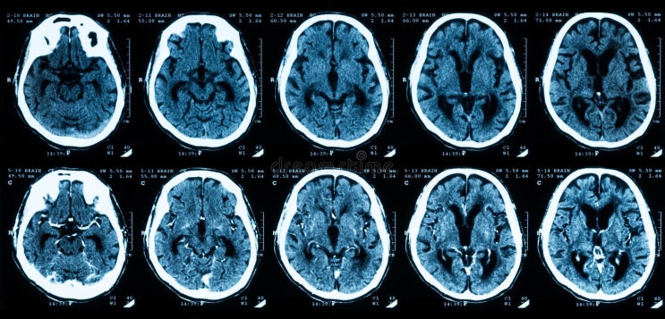 뇌 CT(Overview of Brain CT) : 네이버 블로그