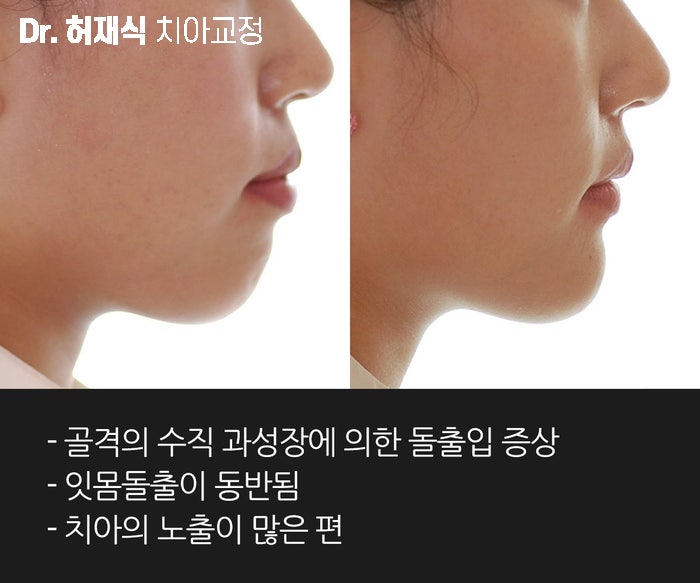 돌출입 치아교정 후 턱변화 사례_무턱, 직선턱, 긴턱 : 네이버 블로그