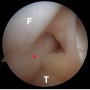 외측 반월상 연골의 양동이 손잡이형 파열(Bucket handle tear of lateral meniscus)
