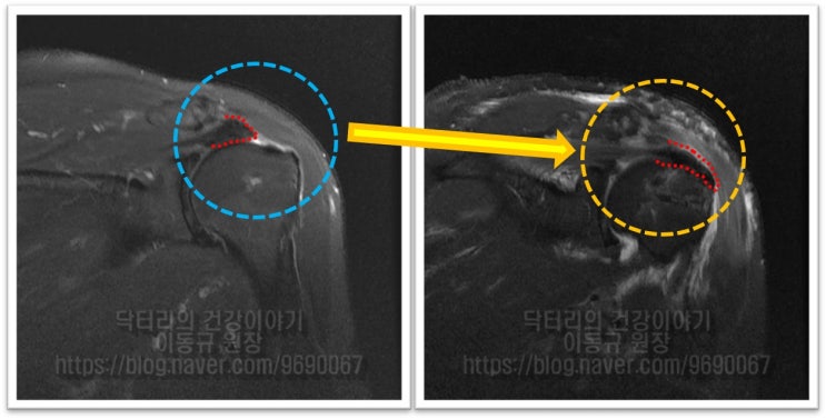 어깨 회전근개 파열 : 보다 단단하게 봉합하는 이열봉합법