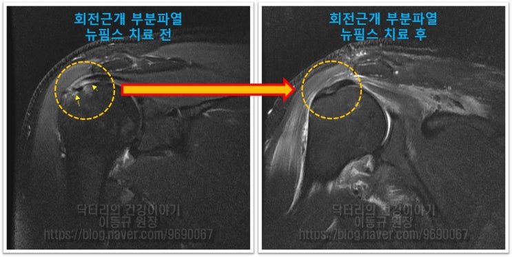 회전근개 부분파열은 어떻게 치료하나? 비수술적치료 회복되나?