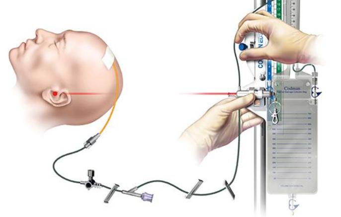 [NS]뇌실외 배액 : EVD (external ventricular drain) : 네이버 블로그