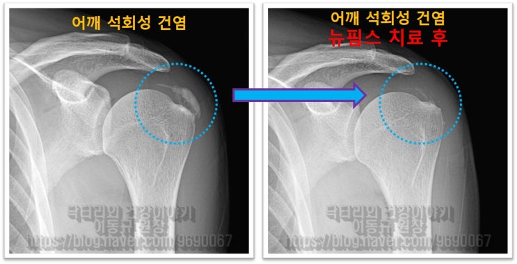 어깨 석회성 건염 : 수술하지 말고 치료하자!