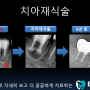 신경 치료 실패 후 치아재식술