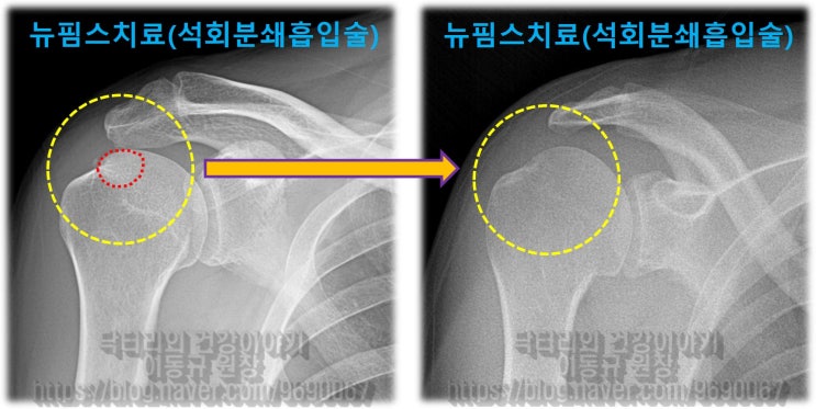 극심한 통증의 어깨 석회성 건염. 근본적 치료는?