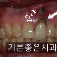 [부천치과/부천상동치과/부천상동임플란트] 앞니 임플란트를 하고 싶어요. (임플란트 VS. 브릿지)