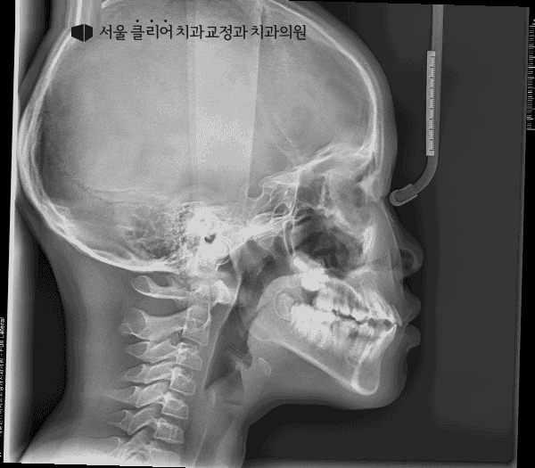아래턱 성장을 멈출 수는 없나요? : 네이버 블로그