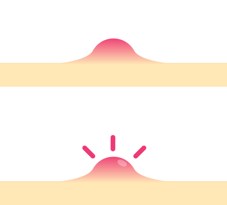 피부 종기에 대하여~ 종기 원인과 증상, 종기 치료와 예방법 : 네이버 블로그
