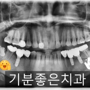 [부천상동치과/임플란트/상동임플란트/기분좋은치과] 신뢰가는 치과에서 임플란트 하세요