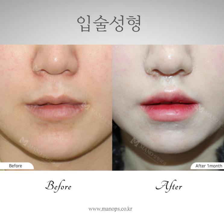 입술 커지는 법 입꼬리수술 알아보기 : 네이버 블로그