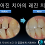 [전치부 레진] 벌어진 앞니의 레진 치료