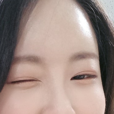 이마필러 3개월 후기! 이마필러 1cc 3cc? (+ 붓기, 가격, 부작용,전후 차이) : 네이버 블로그 이마필러 3개월 후기! 이마필러 1Cc 3Cc? (+ 붓기, 가격, 부작용,전후 차이) : 네이버 블로그