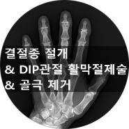 [부산 성가병원] DIP관절 통증을 호소하는 환자분께 결정종 절개, DIP관절의 활막절제술, 론저를 이용한 골극 제거술을 시행하였습니다.