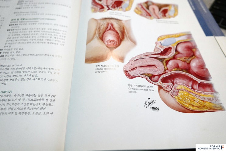 shows prolapse staging 4-0, I, II, III, IV. (uterine-by the position of