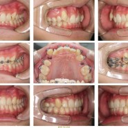 그 동안의 치아교정 증례들 (광주올바른치과 교정과)