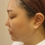 턱밑살, 이중턱 청담피부과 페이스유스키니 받고 리프팅까지(안면윤곽주사x 이중턱지방흡입x)