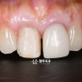 앞니 오래된 치아 라미네이트 떨어짐/깨짐, 재치료를 통해 자연 치아에 어울리는 색상으로 교체