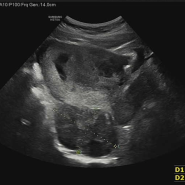 [임신] 11주차. 배불뚝이, 아니 벌써? 임신 후 배나오는 시기
