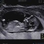 육아일기 : 임신 12주차, 고혈압 그리고 몸쑤심