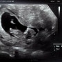 [임신] 21.11.03 임신 11주차(11w2d) ♥ 1차 기형아 검사