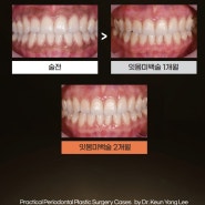 참치과 잇몸미백(치은미백) 증례