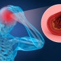 혈관성두통인 편두통과 군발두통 및 경추성두통과 자율신경