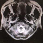머리 MRI (brain MRI)촬영중 만난 귀요미 : 뇌무룩~;