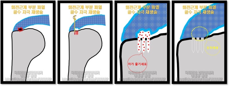 회전근개 부분파열! 골수 자극 줄기세포 재생술로 수술 없이 치료!!!