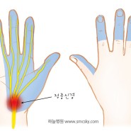 손목터널증후군 저림 증상 및 치료, 자가진단, 손목 스트레칭 및 운동, 보호대