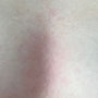 코로나 후유증 피부 트러블 (피부염, 한랭두드러기 콜린성?...)